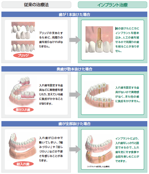 インプラント