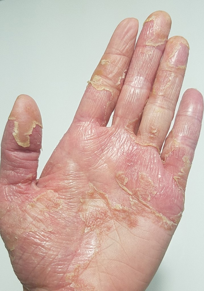 掌蹠膿疱症（しょうせきのうほうしょう）と金属アレルギー