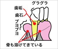 歯周病