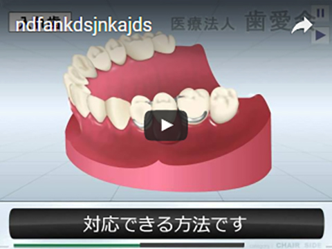 動画で、インプラントや歯周病を知ろう！